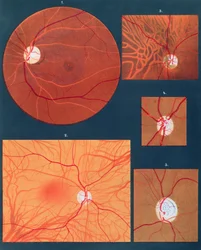 Das Auge durch ein Mikroskop gesehen, aus Atlas der Ophthalmoskopie, veröffentlicht in Paris, 1870